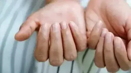 أسباب هشاشة الأظافر وطرق علاجها