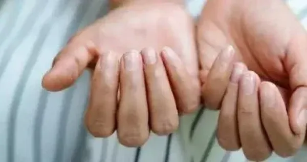 أسباب هشاشة الأظافر وطرق علاجها