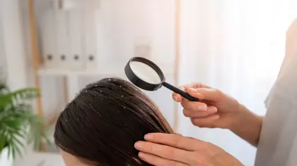 تفسير رؤية القمل الأسود في المنام