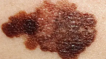 علاج مركب جديد لسرطان الجلد يقلل الانتكاس والوفاة