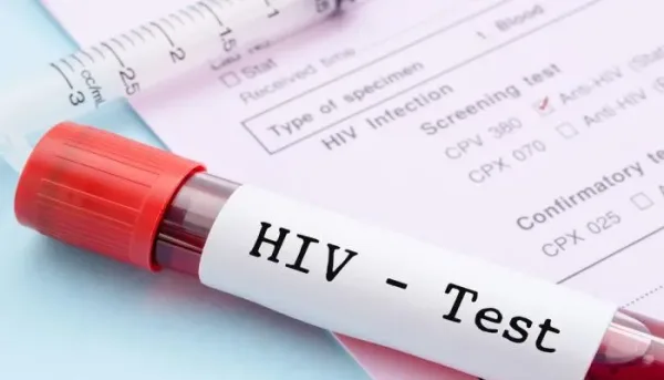 تحليل فيروس نقص المناعة البشرية (HIV) وأنواعه