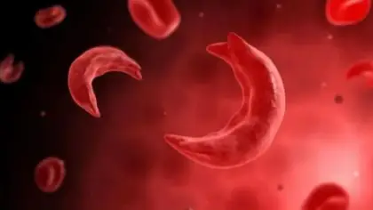 فقر الدم المنجلي: الأعراض والأسباب والوقاية والعلاج