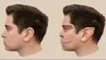 اضطراب تشوه الوجوه (PMO) وأعراضه