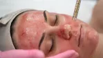 مخاطر حقن البلازما الغنية بالصفائح الدموية للوجه
