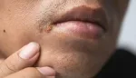 آلية غزو فيروس الهربس للجهاز العصبي