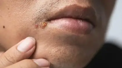 آلية غزو فيروس الهربس للجهاز العصبي