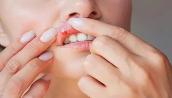 متلازمة بهجت: الأعراض والتشخيص والعلاج والوقاية