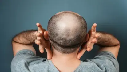 سكر الديوكسي ريبوز وإمكاناته في علاج الصلع
