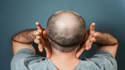 سكر الديوكسي ريبوز وإمكاناته في علاج الصلع