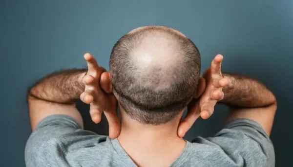 سكر الديوكسي ريبوز وإمكاناته في علاج الصلع