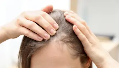 الثعلبة عند النساء: الأعراض والأسباب والعلاج