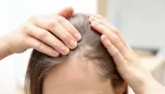 الثعلبة عند النساء: الأعراض والأسباب والعلاج