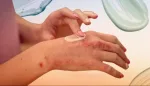 الصدفية: حقائق وأساطير شائعة