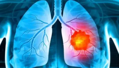 لقاح سرطان الرئة بتقنية mRNA: التجارب السريرية