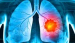 لقاح سرطان الرئة بتقنية mRNA: التجارب السريرية