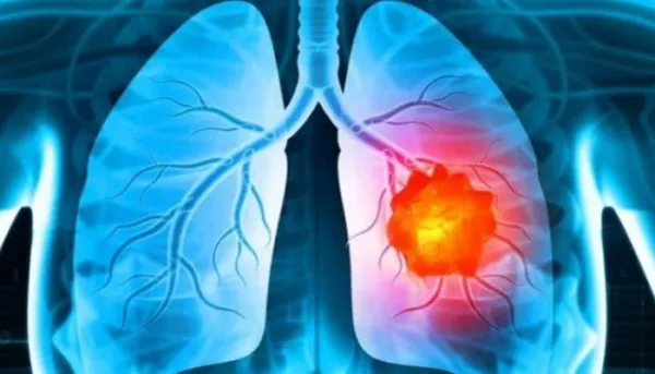 لقاح سرطان الرئة بتقنية mRNA: التجارب السريرية
