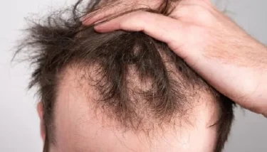 الصيام المتقطع: مخاطره المحتملة على الشعر والقلب