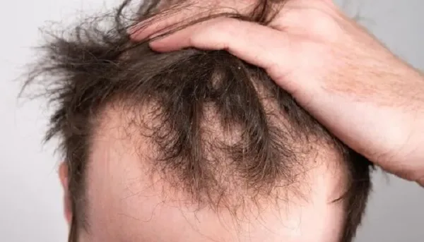 الصيام المتقطع: مخاطره المحتملة على الشعر والقلب