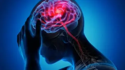 الميكروبلاستيك في الشرايين وعلاقته بالسكتات الدماغية
