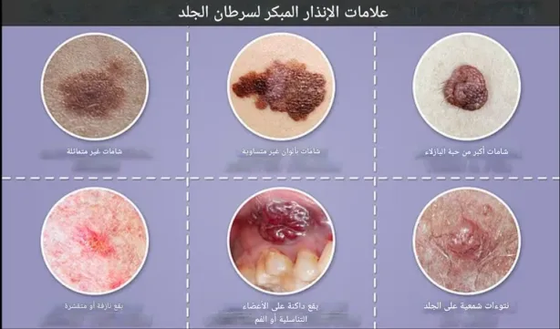مخاطر الشمس على فروة الرأس الصلعاء وسرطان الجلد