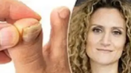 تصلب وتقشر الأظافر: الأسباب والحلول الطبية