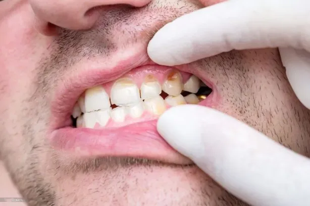 ماذا يخبرك لون أسنانك عن صحتك؟