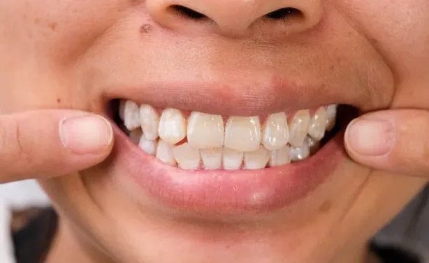 ماذا يخبرك لون أسنانك عن صحتك؟