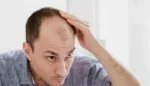 المشروبات السكرية وعلاقتها بتساقط الشعر