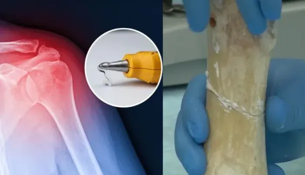تعرف على اللاصق العظمي الصيني Bone-02 الذي يثبت العظام المكسورة خلال دقائق ويُمتص طبيعياً، مقدماً حلاً ثورياً لتقليل…
