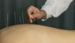 الوخز بالإبر لتخفيف آلام الظهر المزمنة