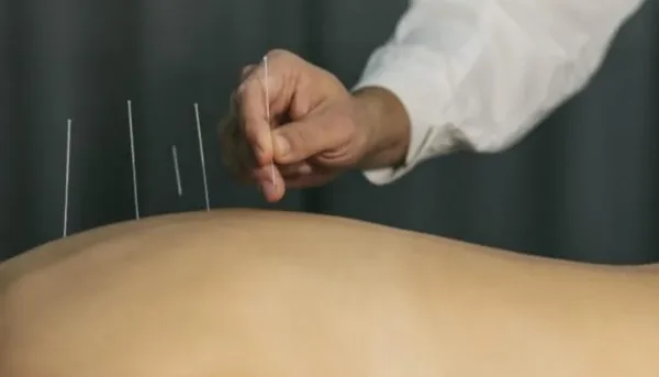الوخز بالإبر لتخفيف آلام الظهر المزمنة
