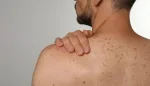 النيكوتيناميد يقلل خطر الإصابة بسرطان الجلد