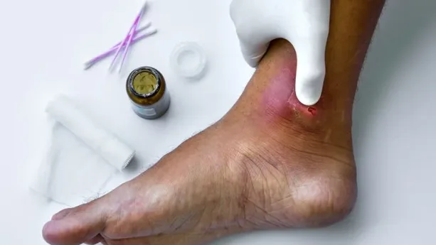علاج تجريبي لمضاعفات السكري والالتهاب المزمن