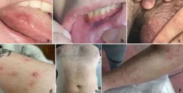 الكشف عن الخريطة الجينية لمرض بهجت في شمال أفريقيا