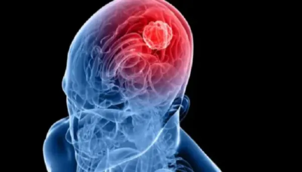 علاج الورم الأرومي الدبقي بقطرات الأنف النانوية