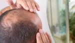 علاج تجريبي للصلع الوراثي عند الرجال