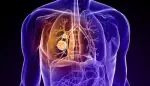 لماذا تتوقف أدوية سرطان الرئة عن العمل وكيف يواجهها الطب الحديث؟