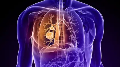 لماذا تتوقف أدوية سرطان الرئة عن العمل وكيف يواجهها الطب الحديث؟