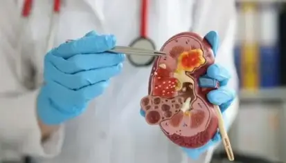 تطور علاج سرطان الكلى بتقنية الغراء الجزيئي