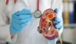 تطور علاج سرطان الكلى بتقنية الغراء الجزيئي