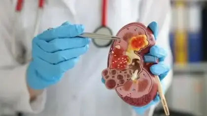تطور علاج سرطان الكلى بتقنية الغراء الجزيئي