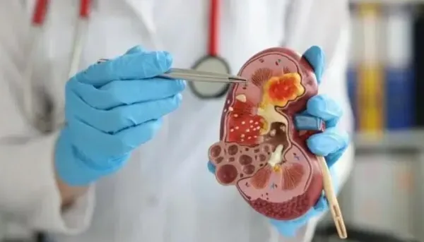 تطور علاج سرطان الكلى بتقنية الغراء الجزيئي