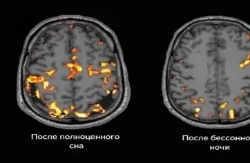 ثلاثة أنماط للنوم مرتبطة بعلامات شيخوخة الدماغ المتسارعة