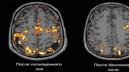 ثلاثة أنماط للنوم مرتبطة بعلامات شيخوخة الدماغ المتسارعة