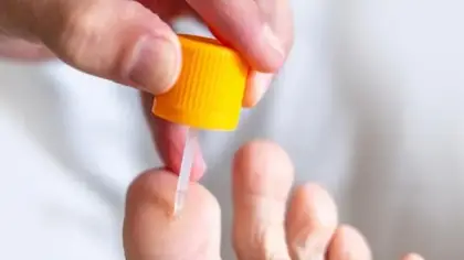 ثآليل اليدين والقدمين: الأسباب والعلاج