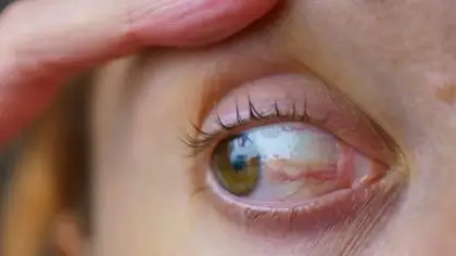 فيروس بحري يسبب مرضاً مزمناً في العين البشرية
