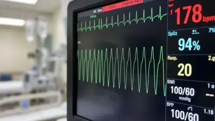 علاج تسارع القلب البطيني بتقنية هجينة