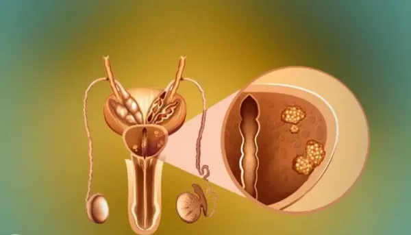 جدل الفحص المبكر لسرطان البروستاتا