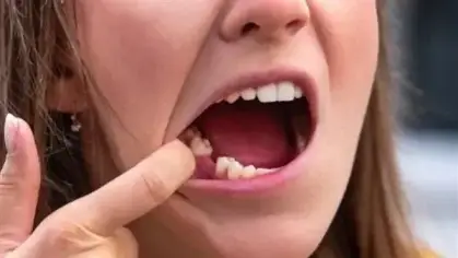 دلالات رؤية خلع الأسنان والضروس في الأحلام