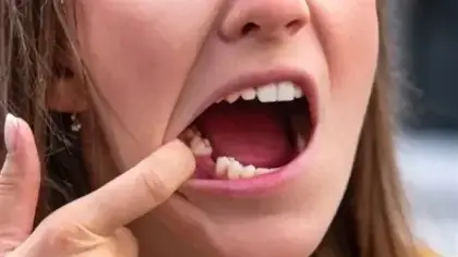 دلالات رؤية خلع الأسنان والضروس في الأحلام